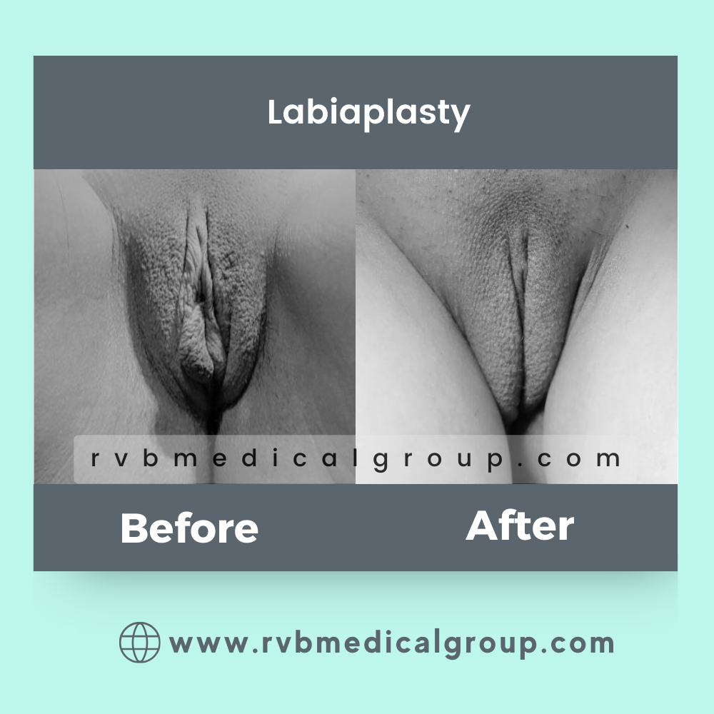 labiaplasty 