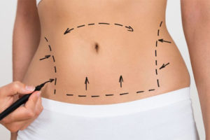 advantages-of-lipoabdominoplasty-liposuction-risk-and-complications-body-contouring-tool