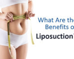 what are the benefits of liposuction