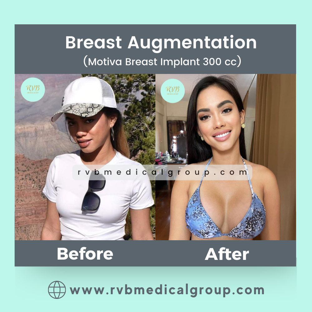 Before After Plastic Surgery Pictures RVB Medical Group