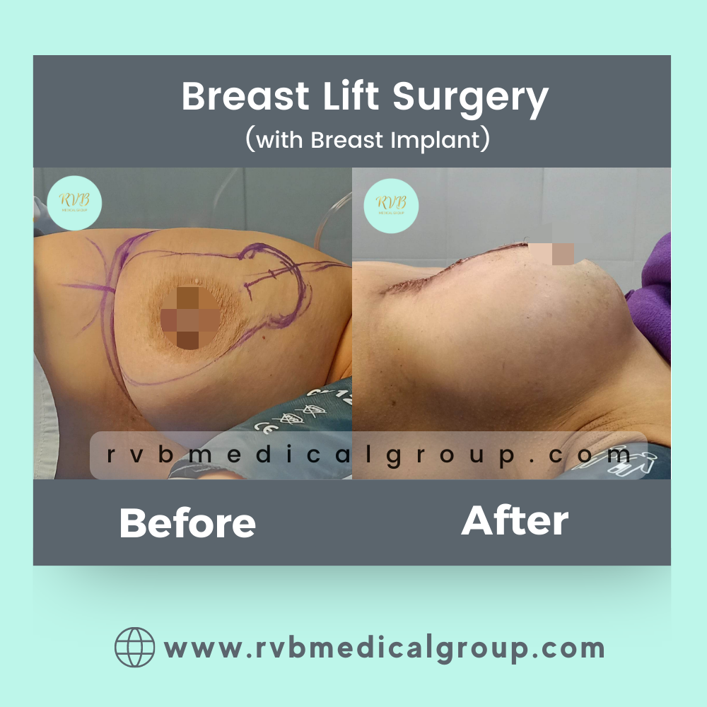 Breast Lift