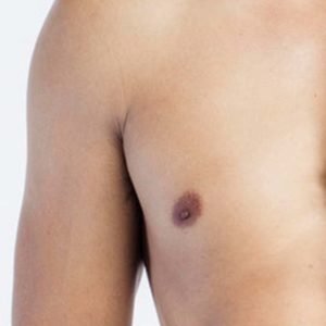 Gynecomastia Surgery