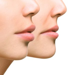 Lip Reduction - Cosmetic Surgery Procedures