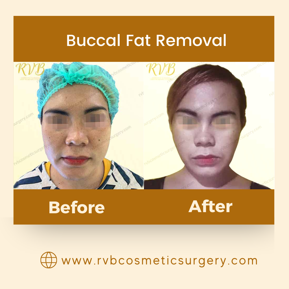 Buccal Fat Removal Philippines candidates, procedure ,result