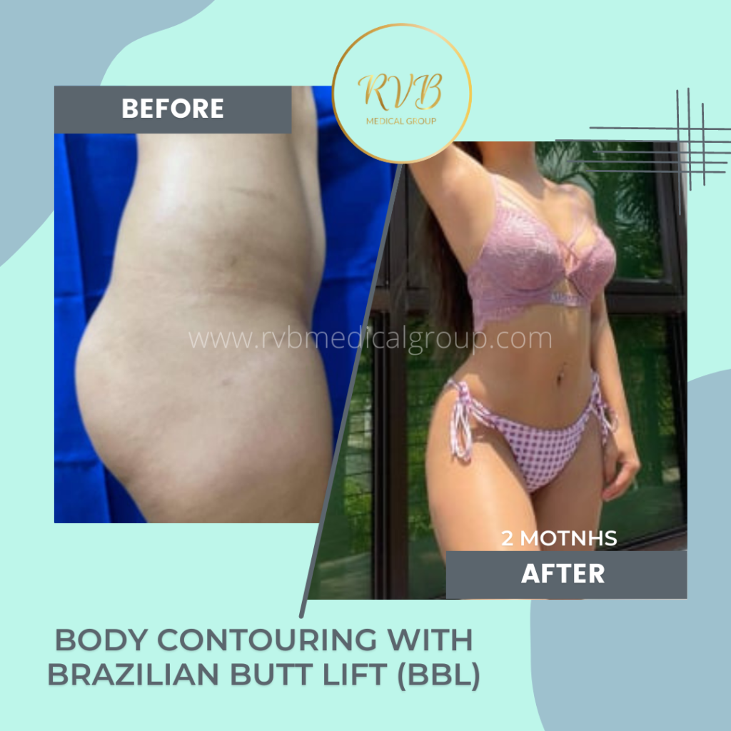 Brazilian Butt Lift Surgery Philippines