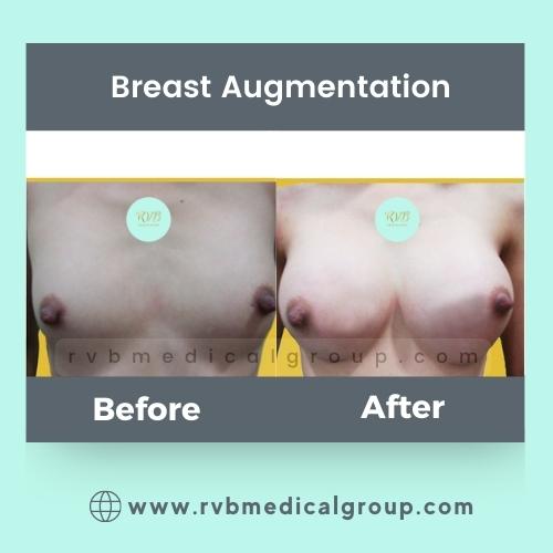 Breast Augmentation Philippines candidates procedure result