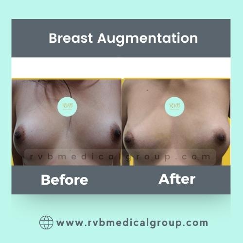 Breast Augmentation Philippines candidates procedure result