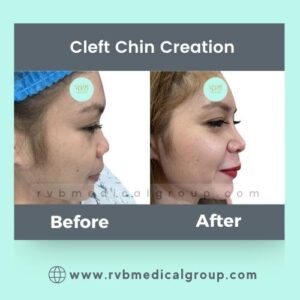RVB Medical Group, Cleft Chin Creation