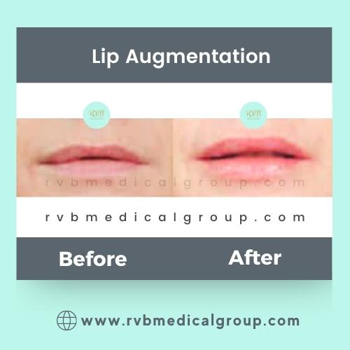 RVB medical Group, lip-augmentation-philippines