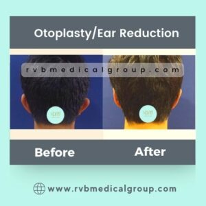 RVB Medical Group, Otoplasty