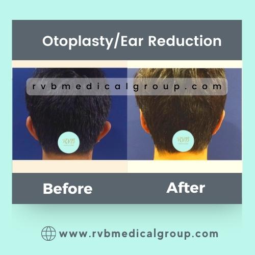 RVB Medical Group, Otoplasty
