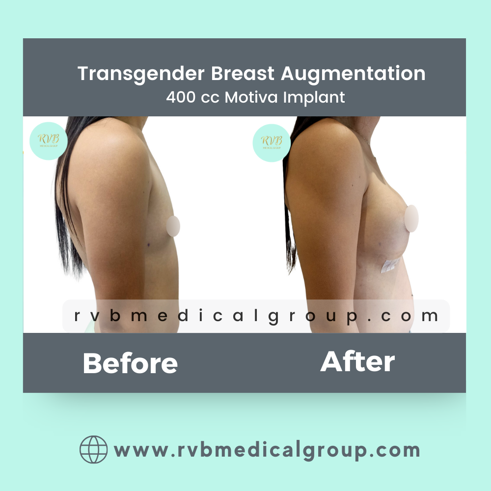 Breast Augmentation Philippines candidates procedure result