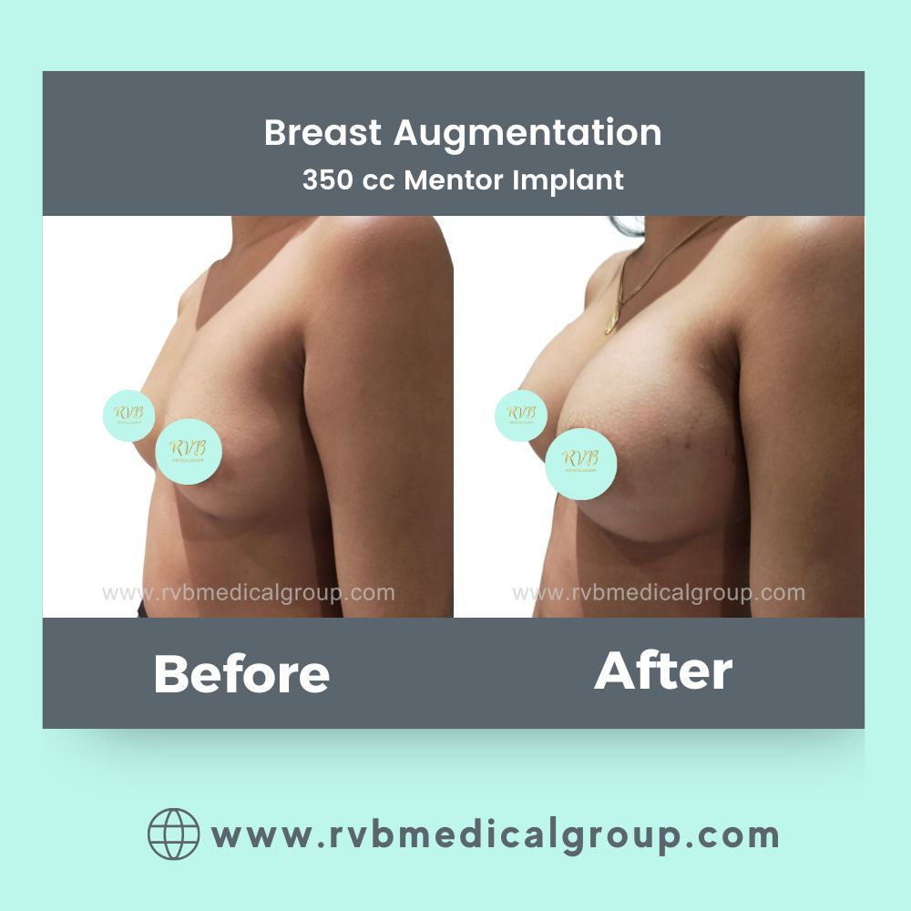 Breast Augmentation Philippines candidates procedure result