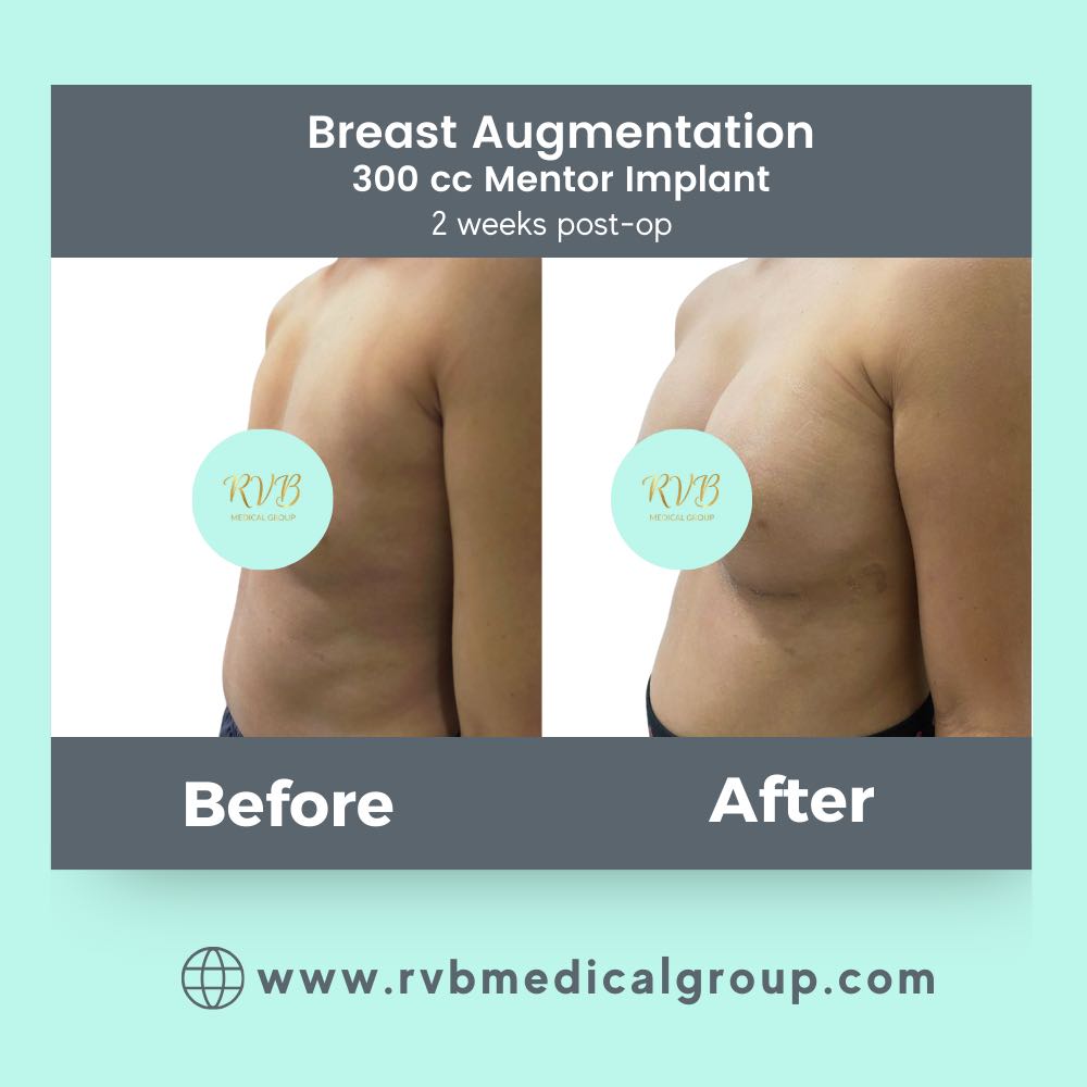 Breast Augmentation Philippines candidates procedure result