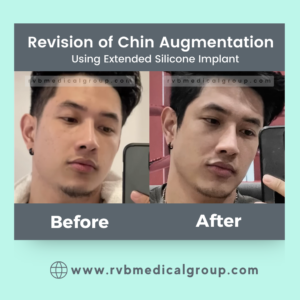 Chin Augmentation of Dr. Gerard Santos by Dr. Romeo V. Bato