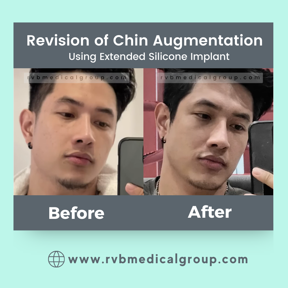 Chin Augmentation of Dr. Gerard Santos by Dr. Romeo V. Bato