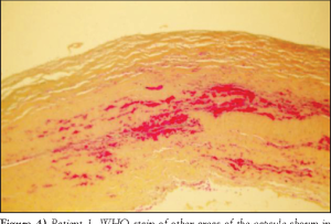 breast-augmentation-hematoma