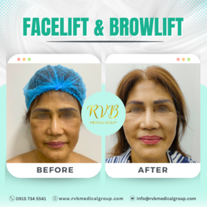 Facelift & Browlift
