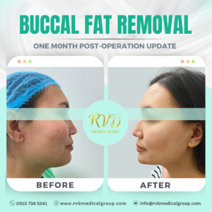 Buccal Fat RVB