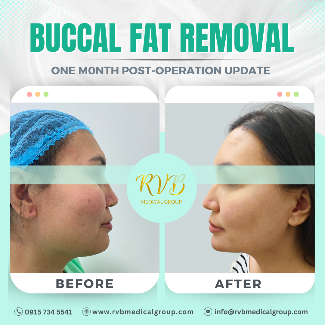 Buccal Fat RVB