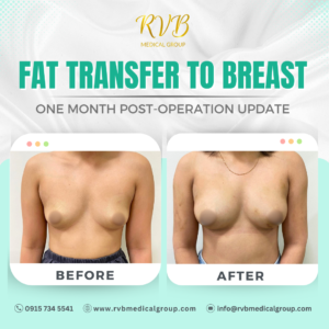 RVB Medical Group - Fat Transfer to Breast