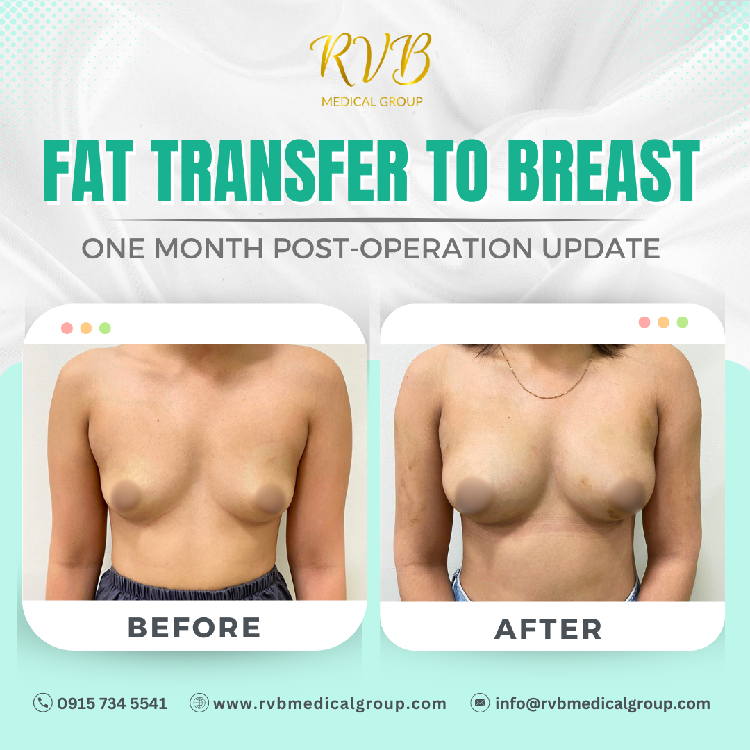 RVB Medical Group - Fat Transfer to Breast