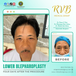 Lower Blepharoplasty