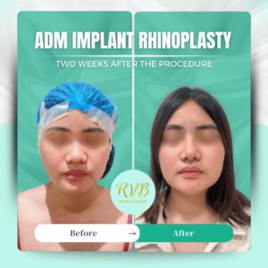ADM Implant Rhinoplasty - RVB Medical Group