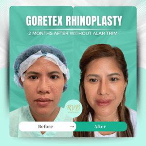 Gorotex Rhinoplasty Before and After - RVB Medical Group