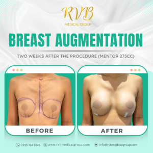 Breast Augmentation - RVB Medical Group