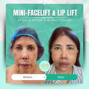 Mini-Facelift & Lip Lift - RVB Medical Group