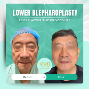 Lower Blepharoplasty