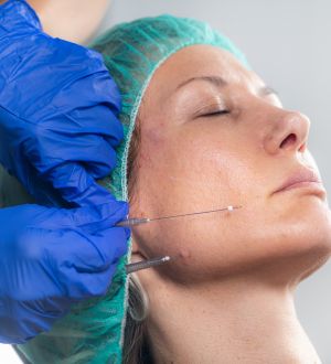RVB Medical Group Thread Lifts & Skin Boosters