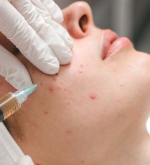 RVB Medical Group Advanced Acne Scar Treatments