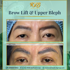 Brow Lift & Upper Bleph RVB Medical Group