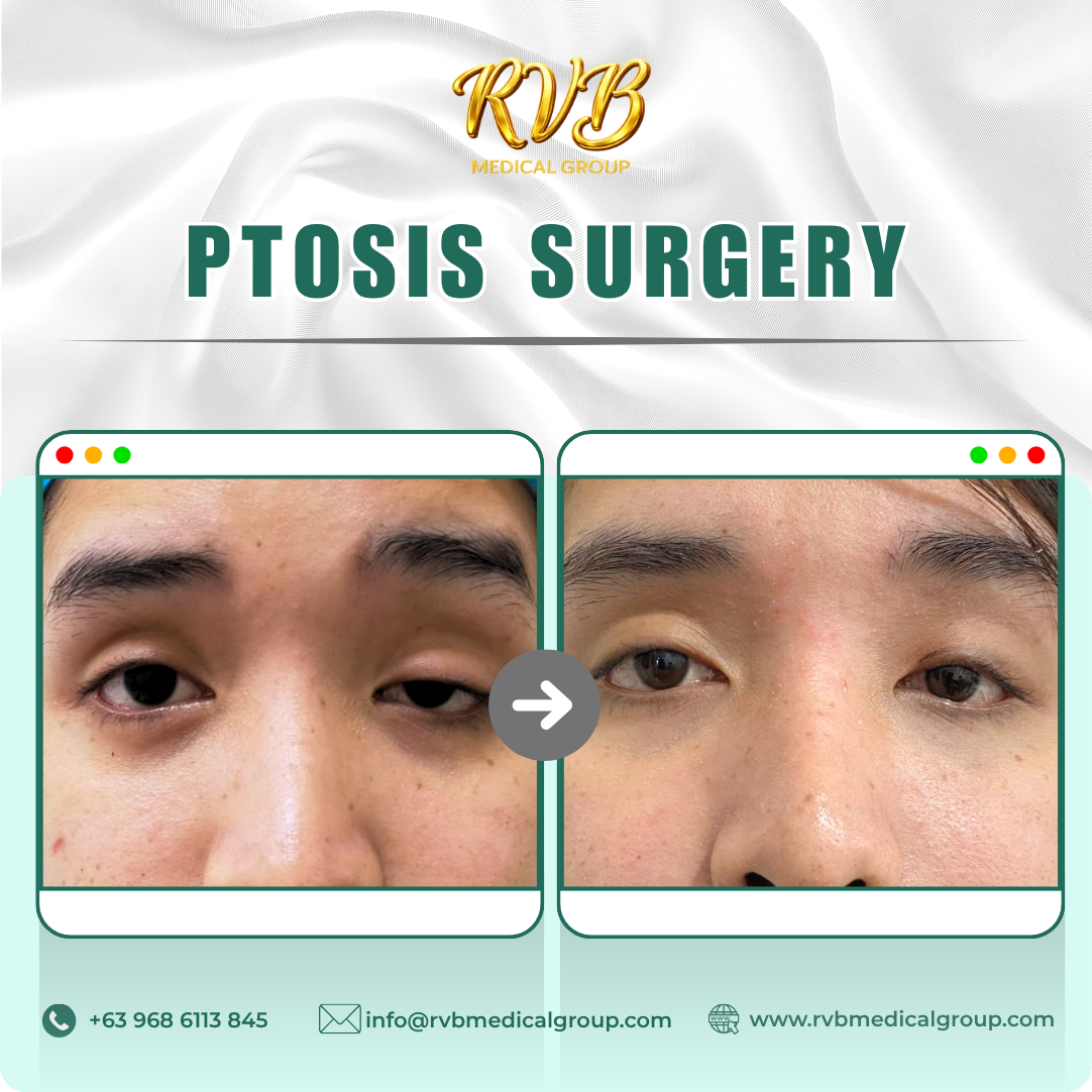Ptosis Correction Surgery