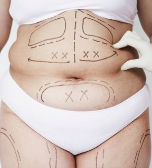 RVB Liposuction