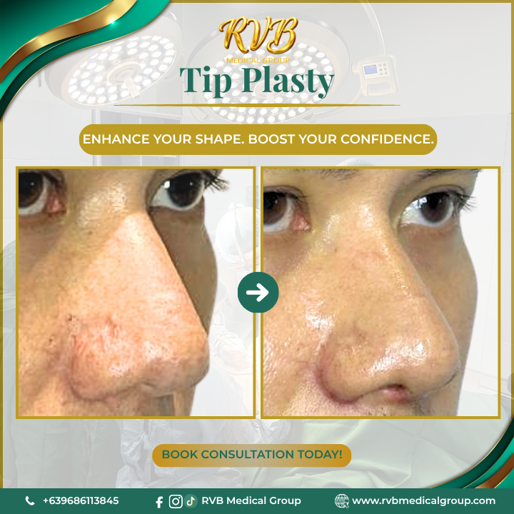 Tip PlastyRVB