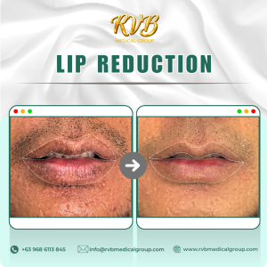 Lip Reduction