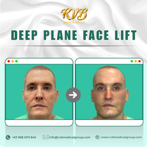 Deep Plane Facelift RVB Medical Group