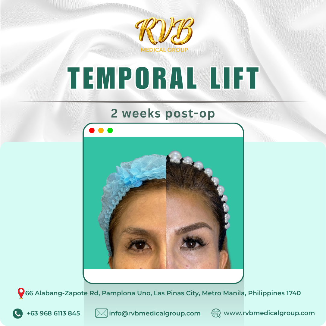 Temporal Lift - RVB Medical Group