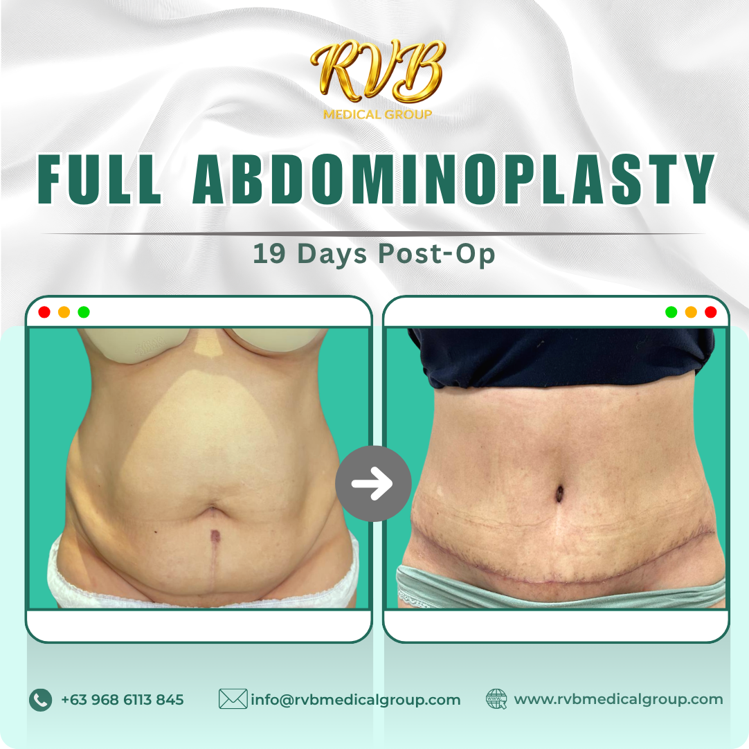 Full Abdominoplasty RVB Medical Group