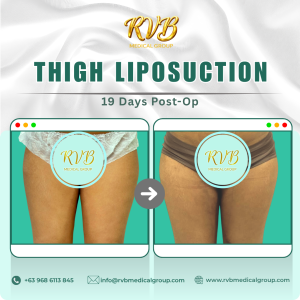 Thigh Liposuction - RVB