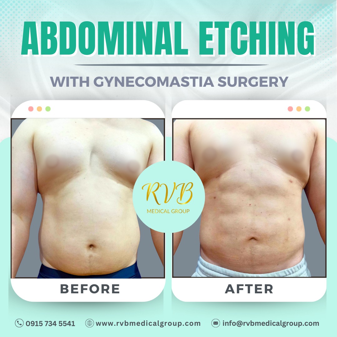 Abdominal Etching RVB Medical Group