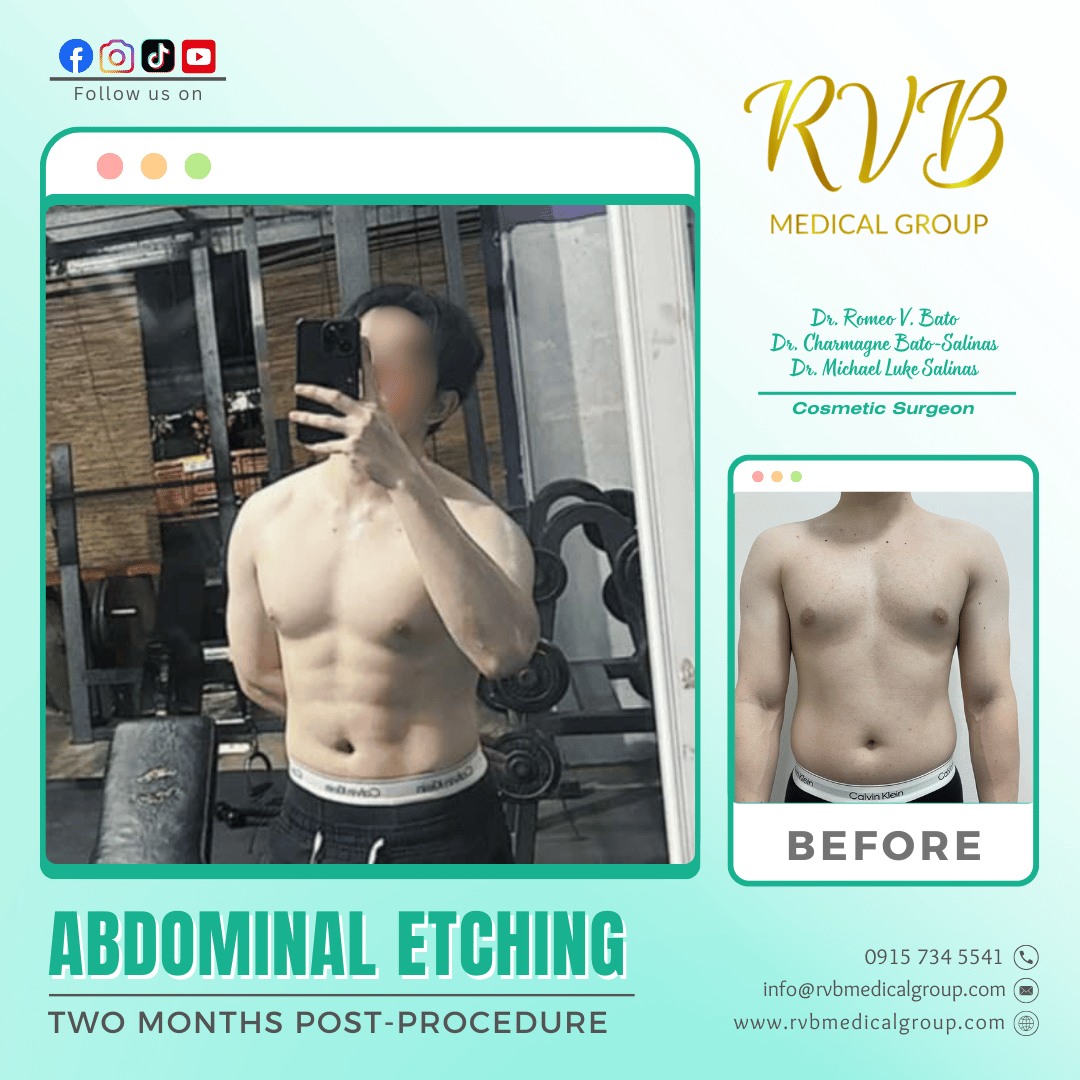 Abdominal Etching RVB Medical Group