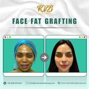 Face Fat Grafting - RVB Medical Group