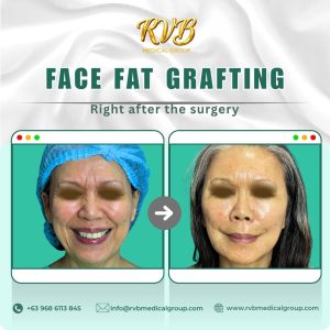 Face Fat Grafting