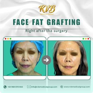 Face Fat Grafting - post op